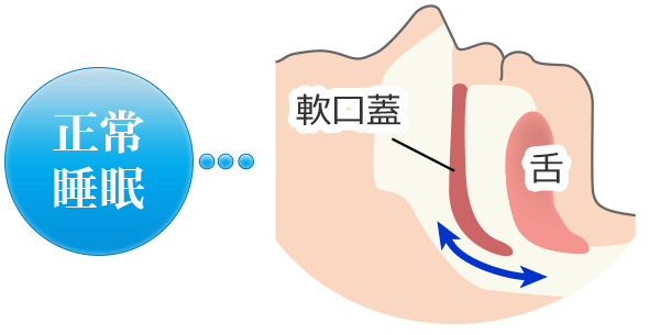 いびきのメカニズム - いびきのない正常な睡眠状態