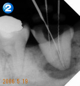End（歯内療法）セミナー 治療例２ 治療経過