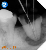 Endo（歯内療法）セミナー 治療例２ 治療経過
