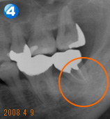 End（歯内療法）セミナー 治療例４ 治療経過