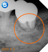 Endo（歯内療法）セミナー 治療例５ 治療後